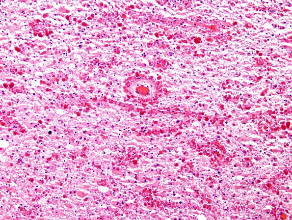 4B3 CGHA (Case 4) Cerebral cortex, little WM H&E 20X