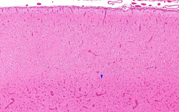 4B4 CGHA (Case 4) Cerebral cortex, little WM  area A 4X copy