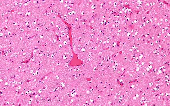 4B5 CGHA (Case 4) Cerebral cortex, little WM  area A H&E 20X