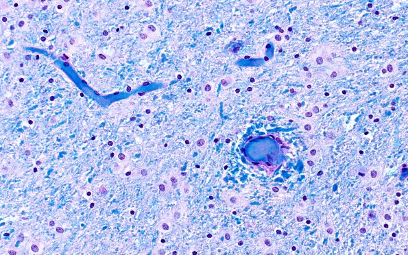 4C6 CGHA (Case 4) LFB-PAS 2