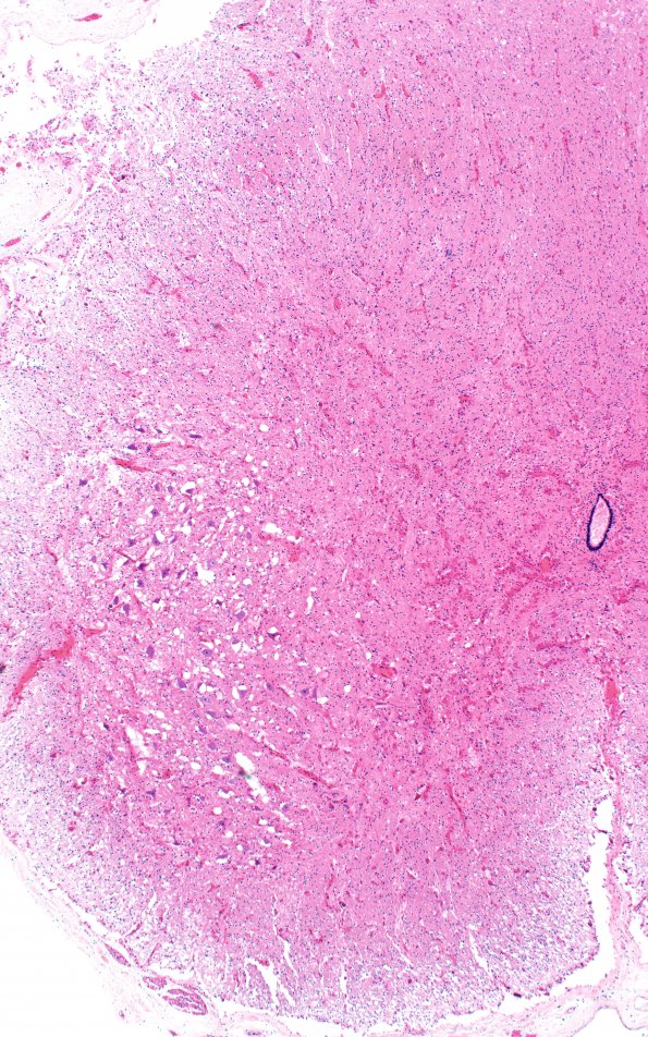 4D1 CGHA (Case 4) Spinal cord H&E 4X