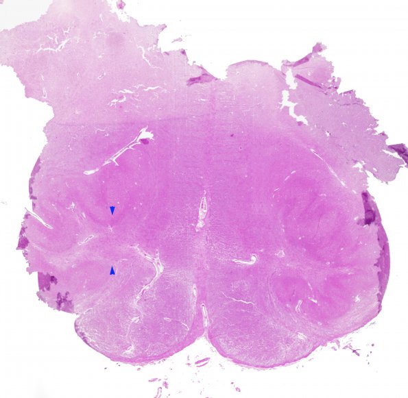 7A1 Alexander Partial (Case 7) Rostral Medulla ION Area H&E WM copy