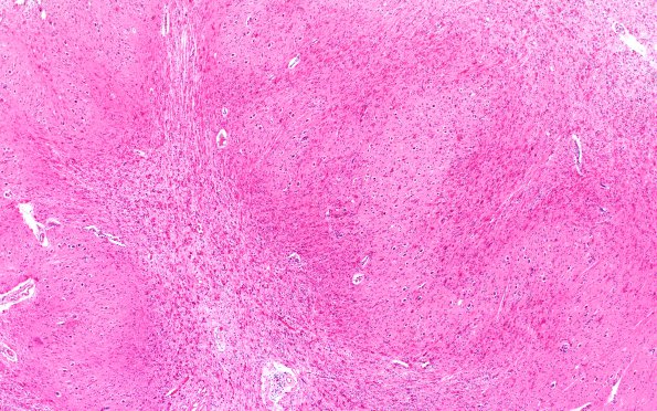 7A2 Alexander Partial (Case 7) Rostral Medulla ION Area H&E 4X