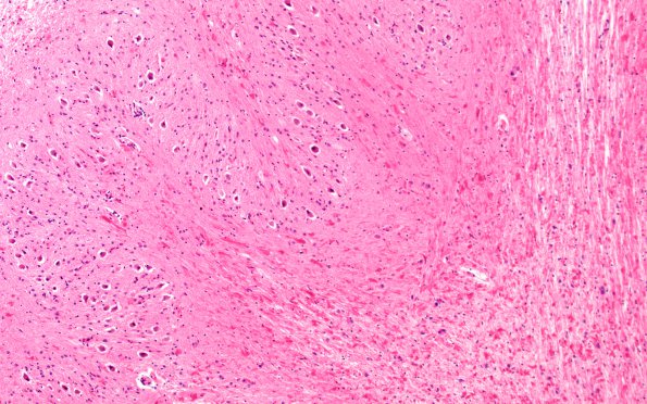 7A3 Alexander Partial (Case 7) Medulla ION Area H&E 20X