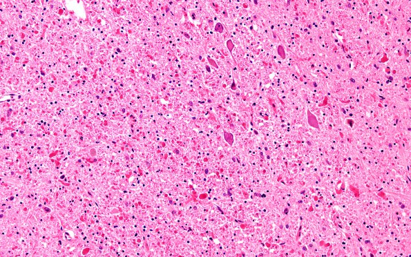 7B3 Alexander Partial (Case 7) Rostral Medulla ION Area H&E 10X