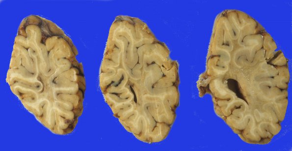 1A7 Binswanger's Dz (Case 1) 6