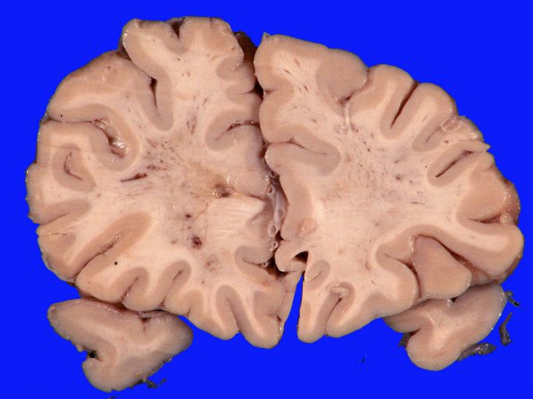 2A2 Binswanger's Dz (Case 2) A_3