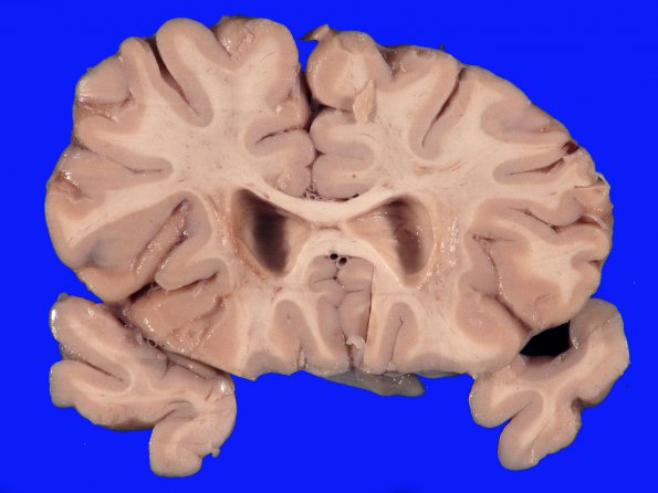 2A3 Binswanger's Dz (Case 2) A_4