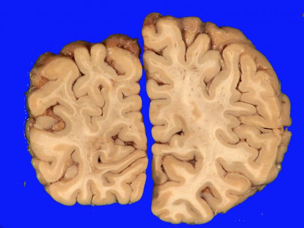 2A7 Binswanger's Dz (Case 2) A_18