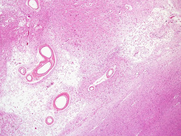 2D2 Binswanger's Dz (Case 2) basal ganglia H&E 2