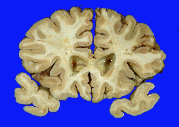 5A1 Binswanger Dz (Case 5) 1A