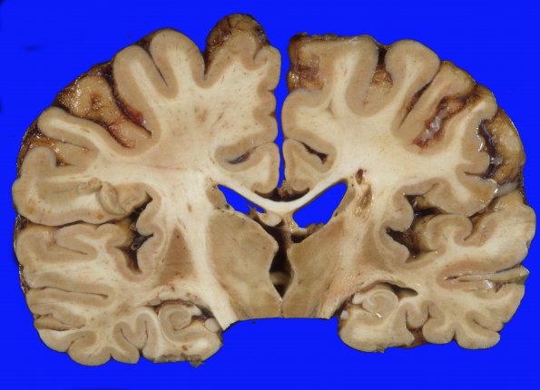 5A3 Binswanger Dz (Case 5) 7A