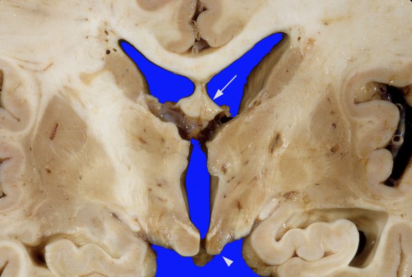 5A5 Binswanger Dz (Case 5) 5A copy