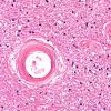 10A1 Arteriolosclerosis, HT (Case 10) N6A H&E 40X 2