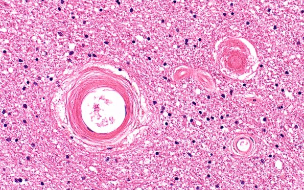 10A1 Arteriolosclerosis, HT (Case 10) N6A H&E 40X 2