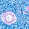 10A2 Arteriolosclerosis, HT (Case 10) N6A LFB-PAS 40X 2