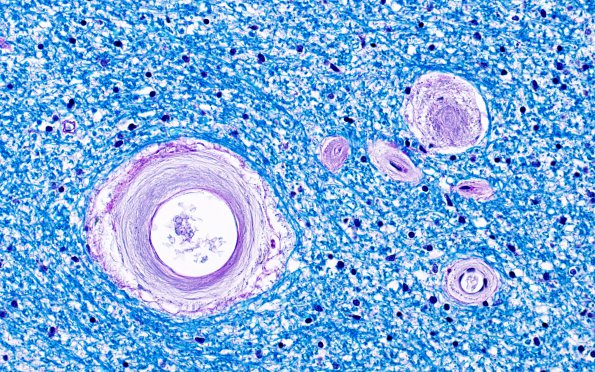 10A2 Arteriolosclerosis, HT (Case 10) N6A LFB-PAS 40X 2