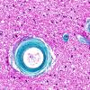 10A3 Arteriolosclerosis, Hypertension (Case 10) N6A Trichrome 40X