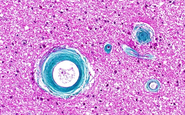 10A3 Arteriolosclerosis, Hypertension (Case 10) N6A Trichrome 40X