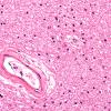 10B1 Arteriolosclerosis, HT (Case 10) N6B H&E 40X