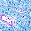 10B2 Arteriolosclerosis, HT (Case 10) N6A LFB-PAS 40X