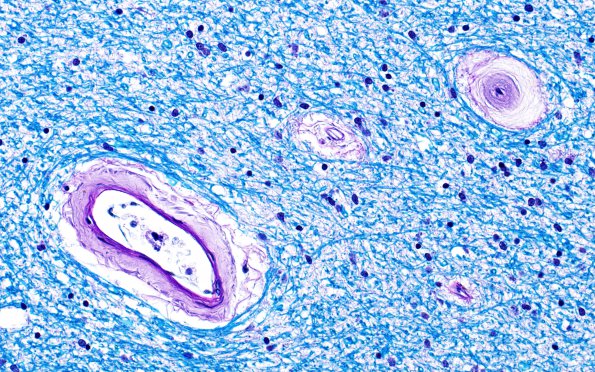 10B2 Arteriolosclerosis, HT (Case 10) N6A LFB-PAS 40X