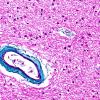 10B3 Arteriolosclerosis, HT (Case 10) N6B Trichrome 40X