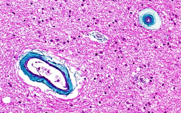 10B3 Arteriolosclerosis, HT (Case 10) N6B Trichrome 40X