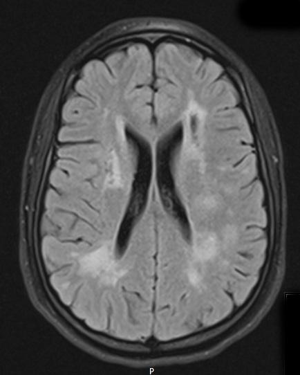11A1 CADASIL (Case 11) FLAIR 2 - Copy