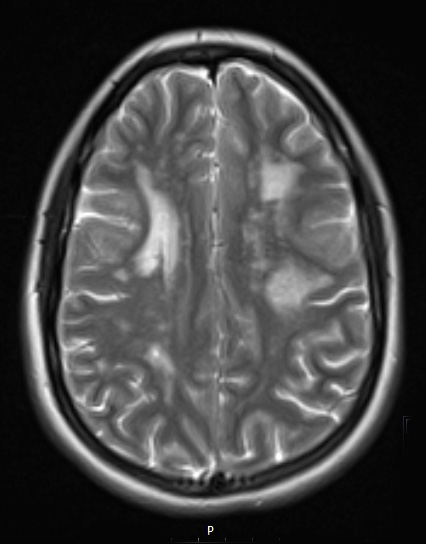 11A4 CADASIL (Case 11) T2  - Copy