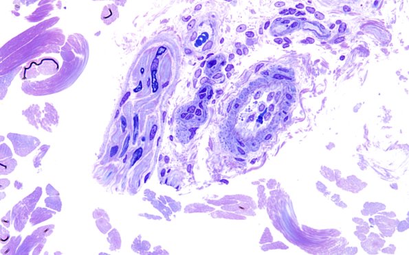 11B1 CADASIL (Case 11) D block 60X 2