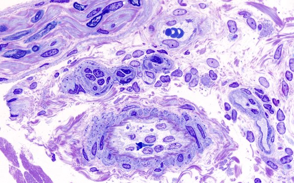 11B2 CADASIL (Case 11) D block 100X 5