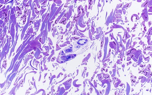 11B3 CADASIL (Case 11) 40X 2