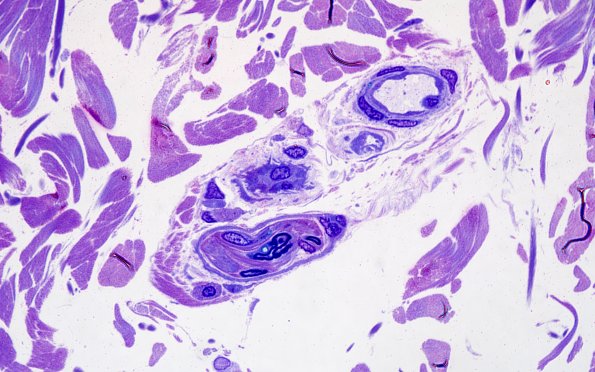 11B4 CADASIL (Case 11) 100X 1