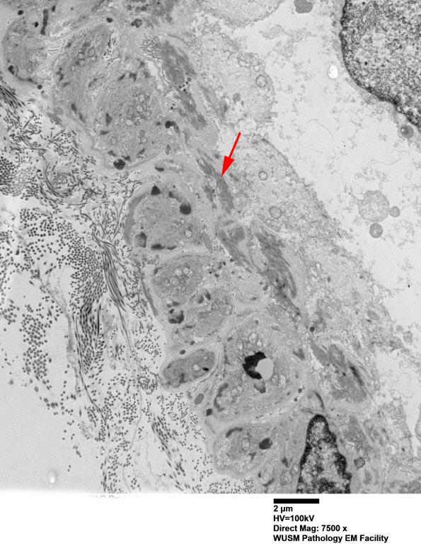 11C1A (Case 11) BlkD skin EM 004 - Copy copy