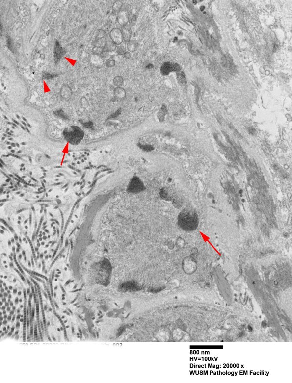 11C1B (Case 11) BlkD skin EM 002 - Copy copy