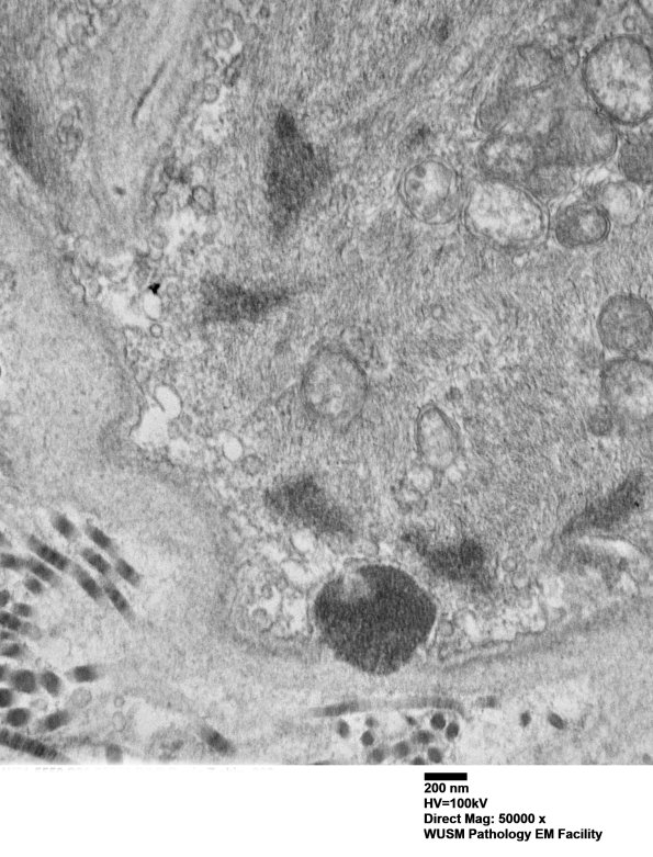 11C1C (Case 11) BlkD skin EM 003 - Copy