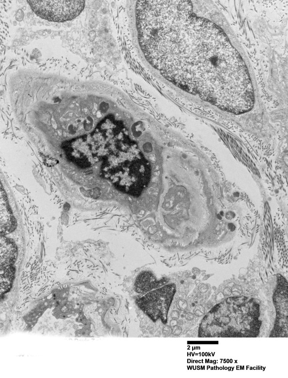 11C2A (Case 11) BlkD skin EM 009 - Copy