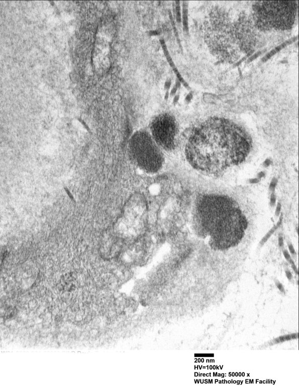 11C2B (Case 11) BlkD skin EM 011 - Copy (2)