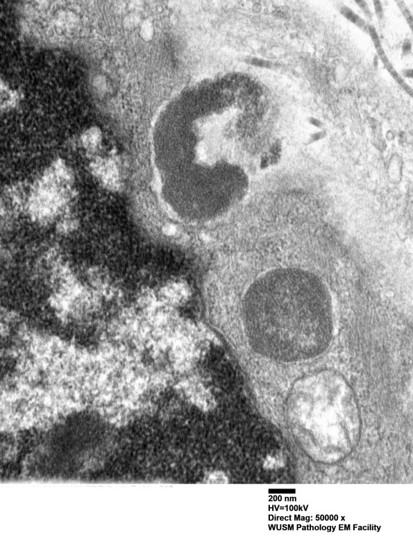 11C2C (Case 11) BlkD skin EM 013 - Copy