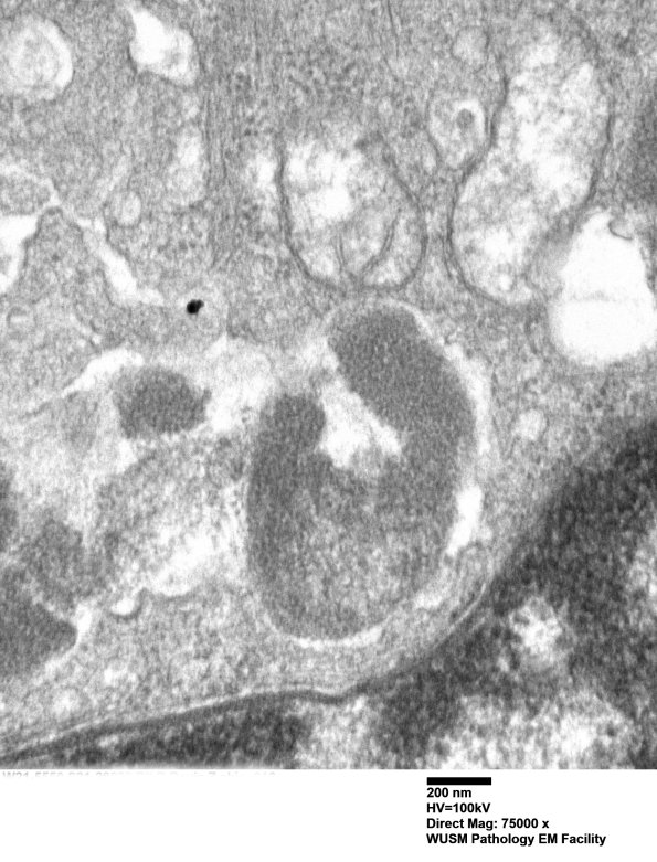 11C2E (Case 11) BlkD skin EM 016 - Copy