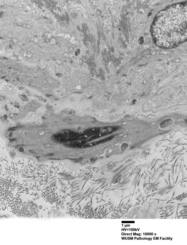 11C3A (Case 11) BlkD skin EM 020 - Copy