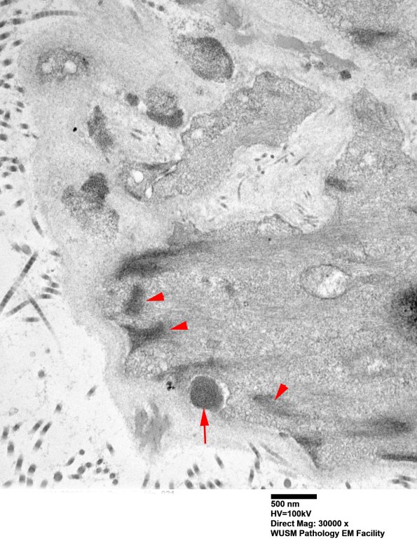 11C3B (Case 11) BlkD skin EM 021 - Copy copy