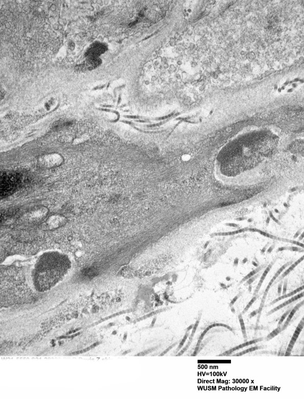 11C3C (Case 11) BlkD skin EM 022 - Copy