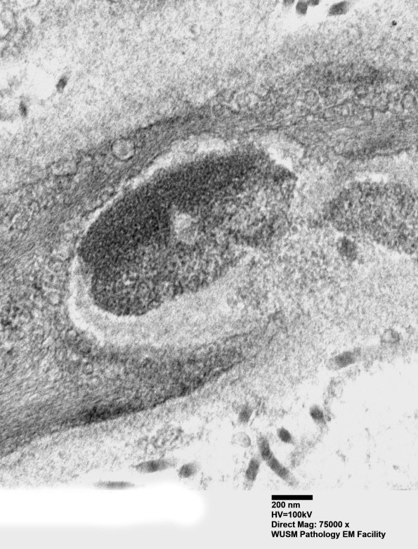 11C3D (Case 11) BlkD skin EM 023 - Copy