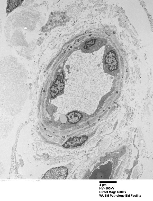 11C4A (Case 11) BlkD skin EM 001A - Copy