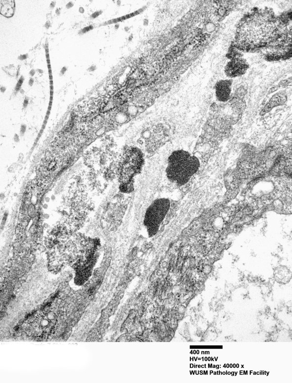 11C4B (Case 11) BlkD skin EM 002 - Copy