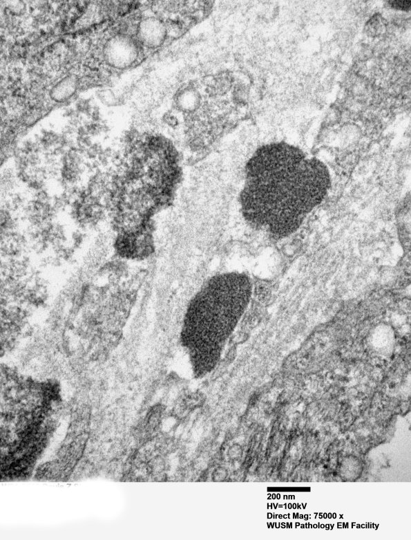 11C4C (Case 11) BlkD skin EM 003 - Copy