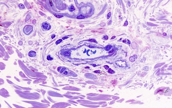 11D3 CADASIL (Case 11) E block 100X 5