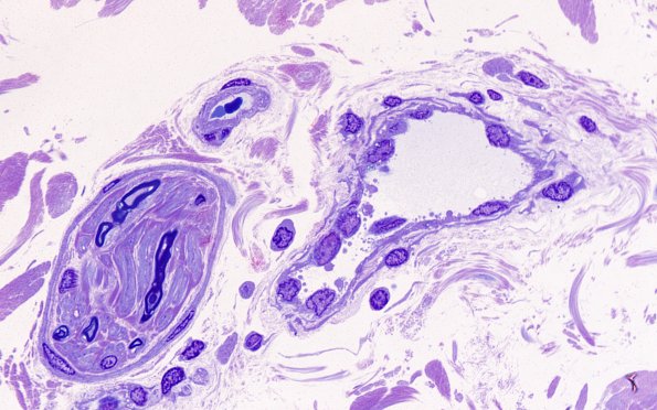 11D4 CADASIL (Case 11) E block 100X 1